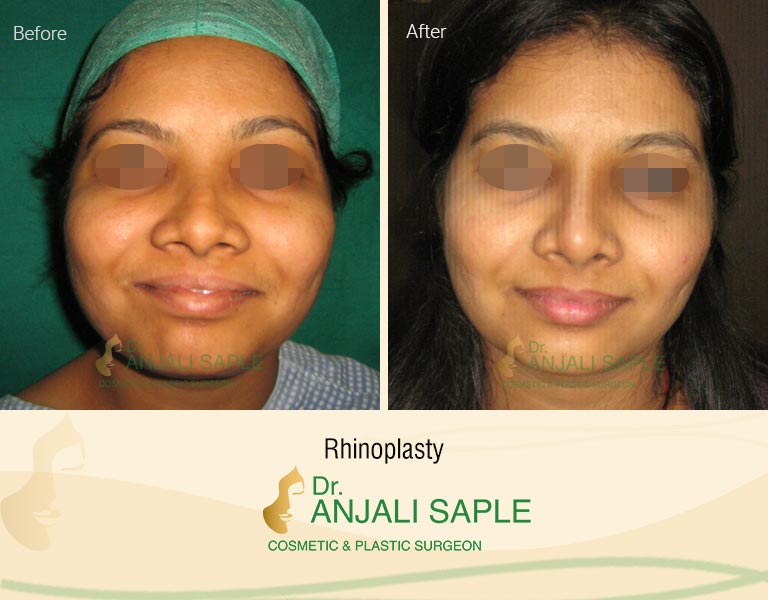 rhinoplasty-before-after-image-front-view