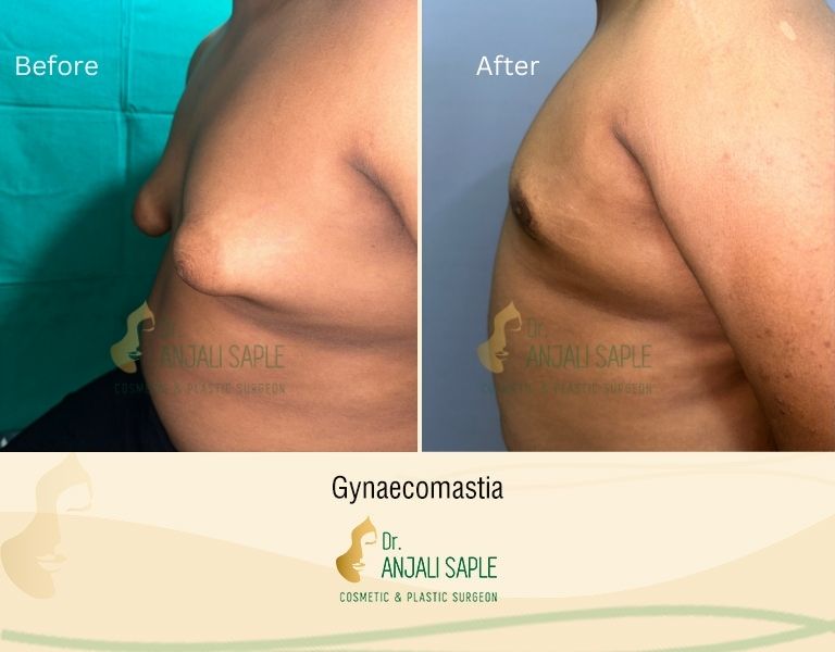 This image shows a before-and-after picture of the patient following surgery at Dr. Anjali Saple Clinic | Tuberous-breast Left View