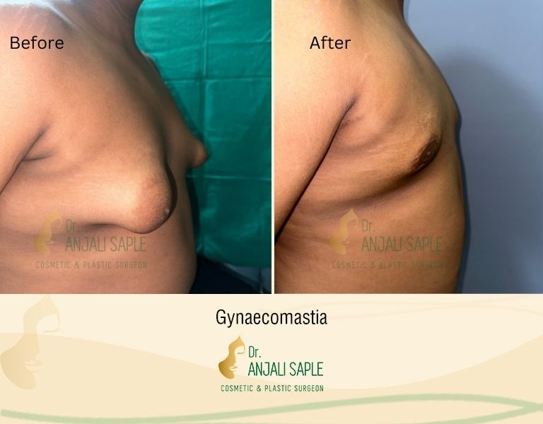 This image shows a before-and-after picture of the patient following surgery at Dr. Anjali Saple Clinic | Tuberous-breast Right View