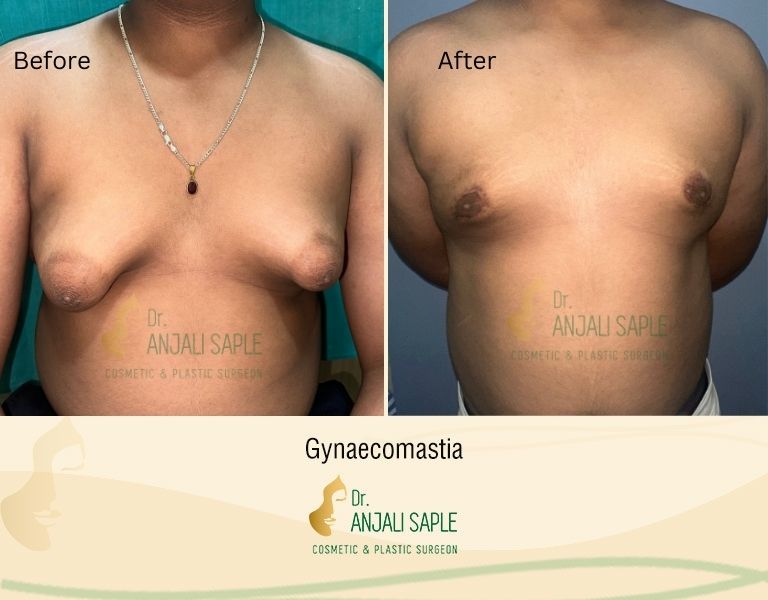 This image shows a before-and-after picture of the patient following surgery at Dr. Anjali Saple Clinic | Tuberous-breast Front View