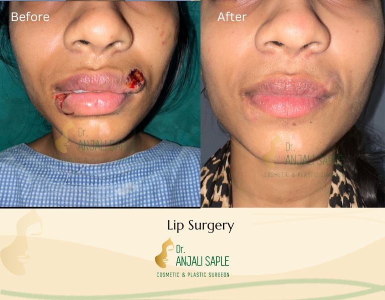 This image shows a before-and-after picture of the patient following surgery at Dr. Anjali Saple Clinic | Lip Injury