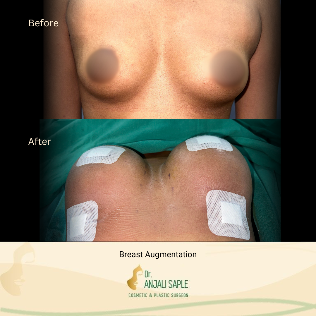 Breast Augmentation