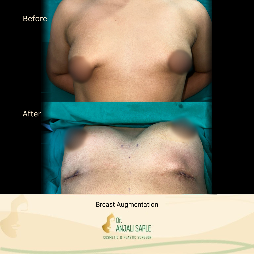 Breast Augmentation