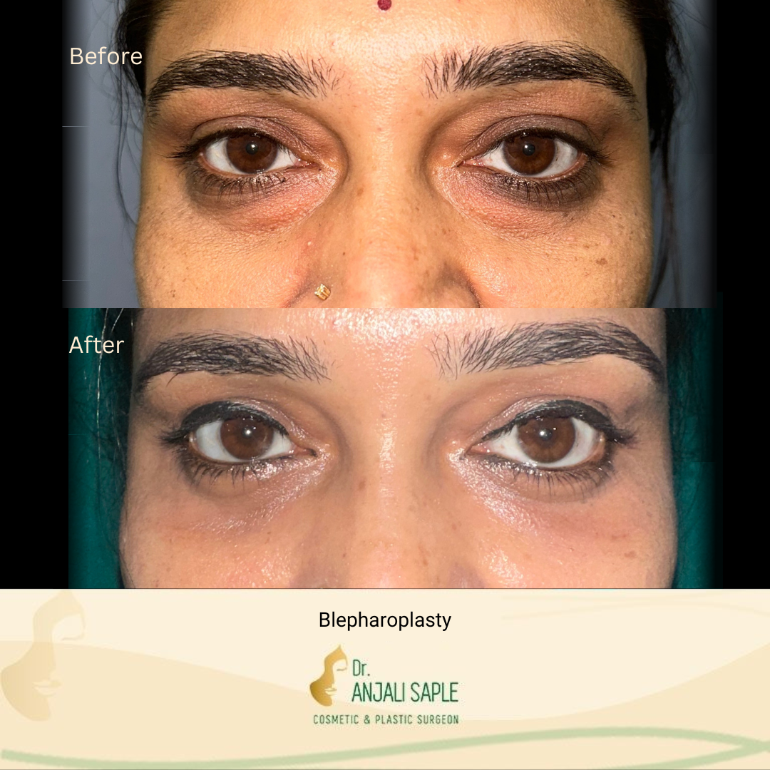 This image shows a before-and-after picture of the patient following surgery at Dr. Anjali Saple Clinic | Blepharoplasty Front view