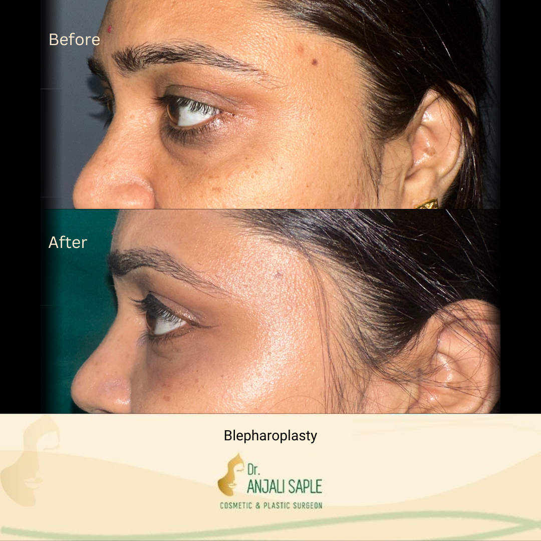 This image shows a before-and-after picture of the patient following surgery at Dr. Anjali Saple Clinic | Blepharoplasty Left view