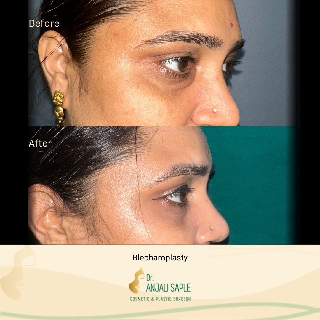 This image shows a before-and-after picture of the patient following surgery at Dr. Anjali Saple Clinic | Blepharoplasty Right view