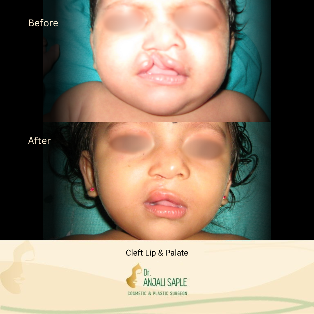 This image shows a before-and-after picture of the patient following surgery at Dr. Anjali Saple Clinic | Cleft Lip Surgery