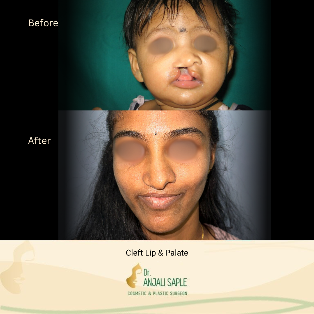 This image shows a before-and-after picture of the patient following surgery at Dr. Anjali Saple Clinic | Brachial Plexus Surgery