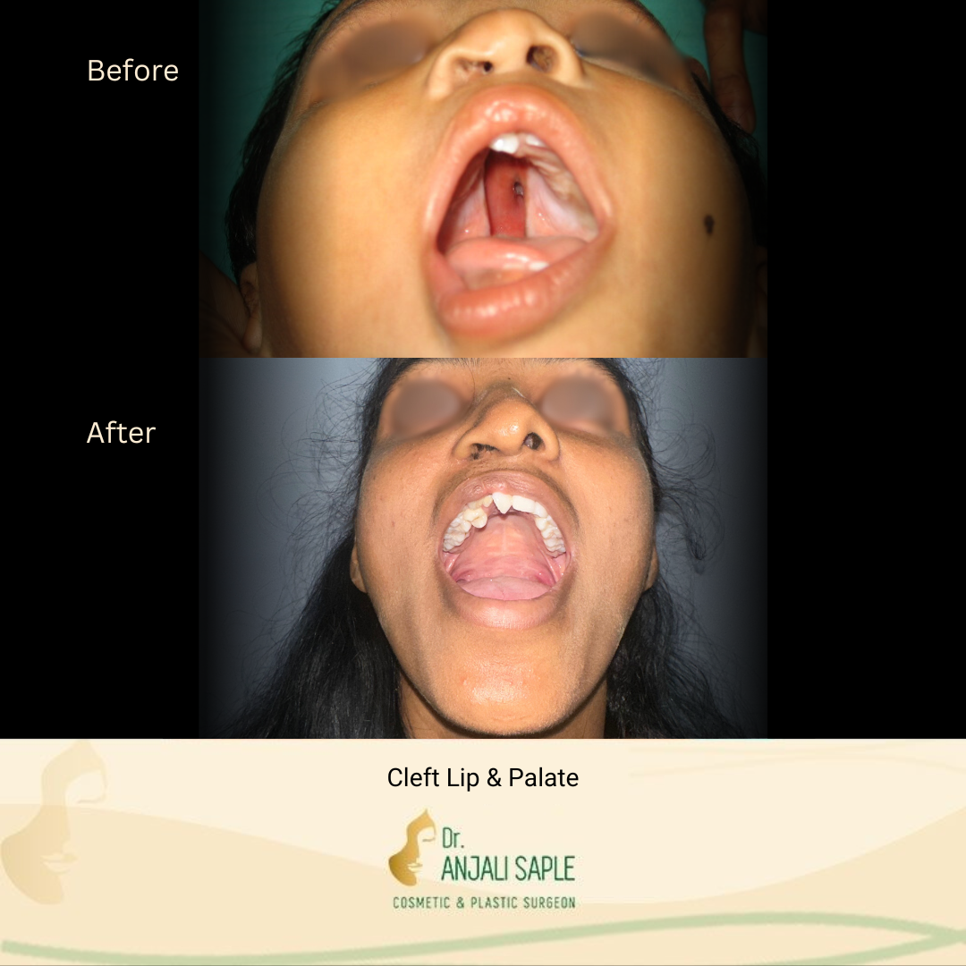 This image shows a before-and-after picture of the patient following surgery at Dr. Anjali Saple Clinic | Brachial Plexus Surgery