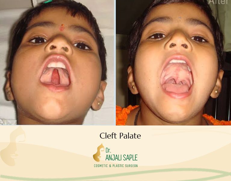 This image shows a before-and-after picture of the patient following surgery at Dr. Anjali Saple Clinic | Cleft Palate Surgery