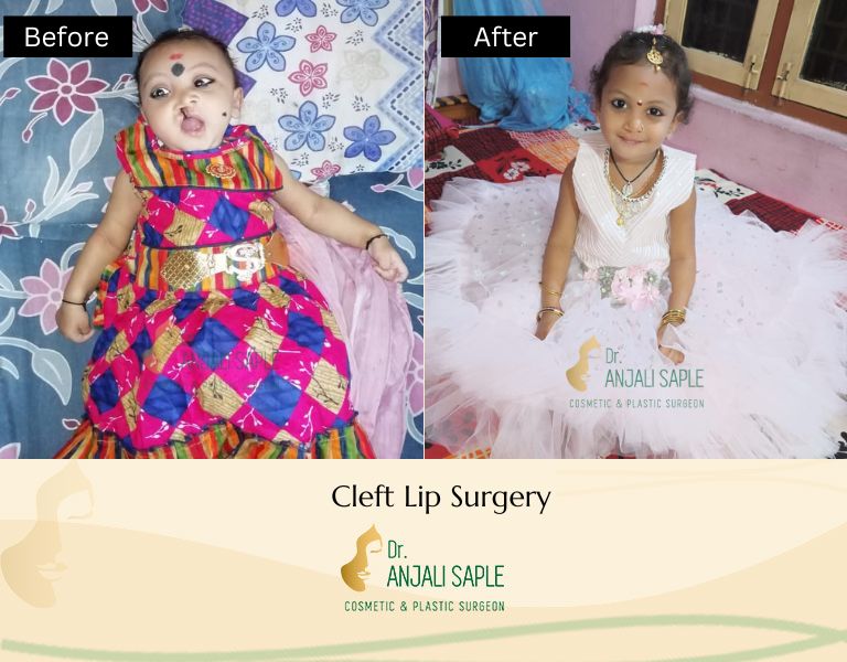 This image shows a before-and-after picture of the patient following surgery at Dr. Anjali Saple Clinic | Cleft Lip Surgery