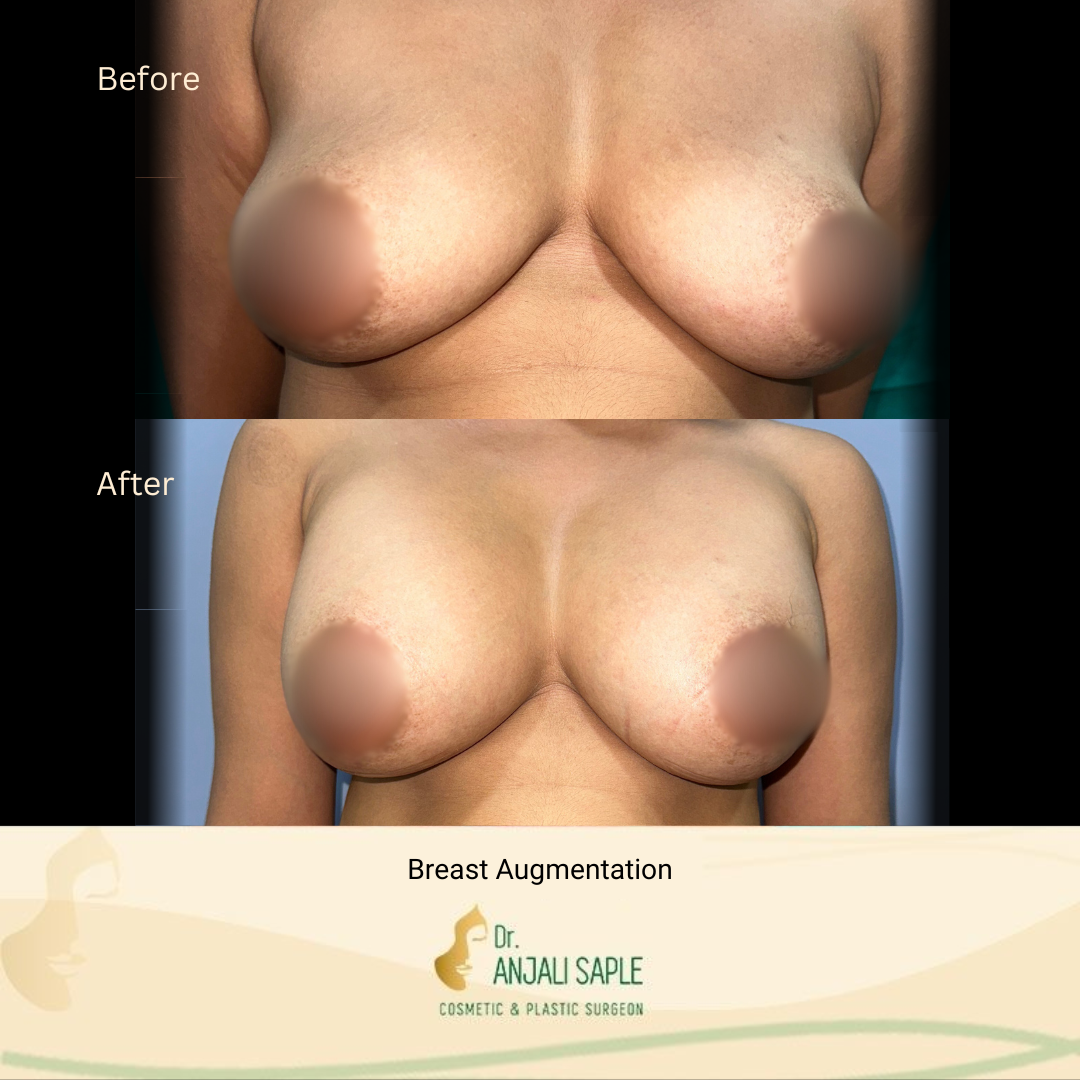 Breast Augmentation Front View