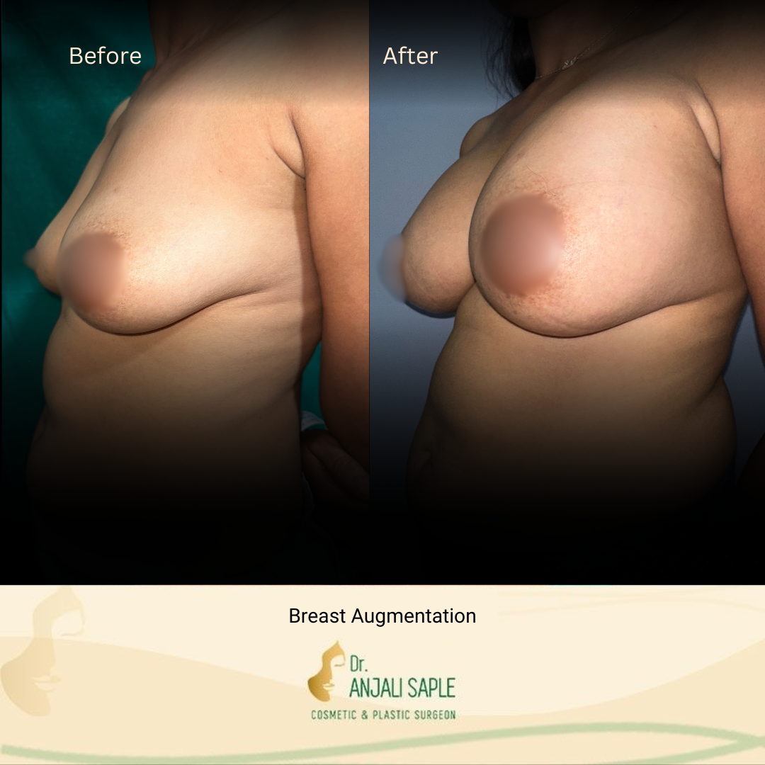 Breast Augmentation Left Side View