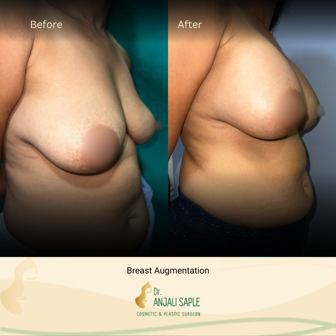 Breast Augmentation Right Side View