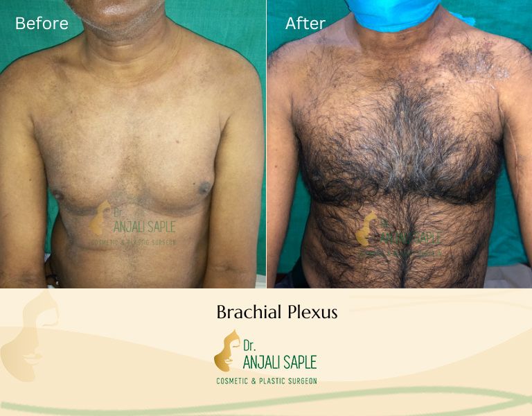 This image shows a before-and-after picture of the patient following surgery at Dr. Anjali Saple Clinic | Brachial Plexus Surgery