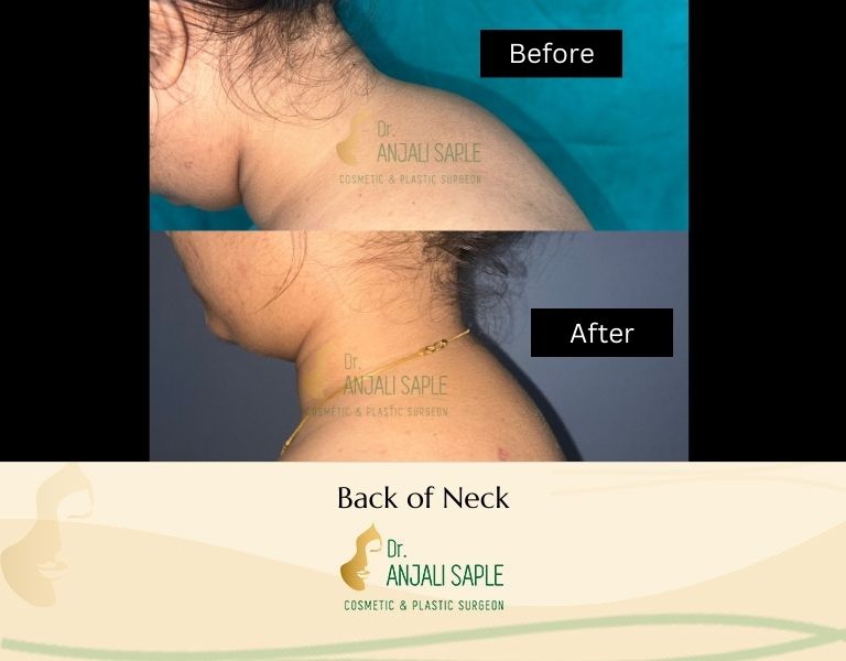 This image shows a before-and-after picture of the patient following surgery at Dr. Anjali Saple Clinic | Neck Left View