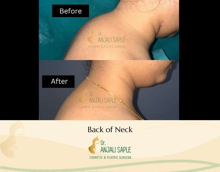 This image shows a before-and-after picture of the patient following surgery at Dr. Anjali Saple Clinic | Neck Right View