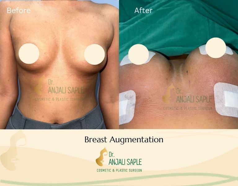 This image shows a before-and-after picture of the patient following surgery at Dr. Anjali Saple Clinic | Breast Augmentation