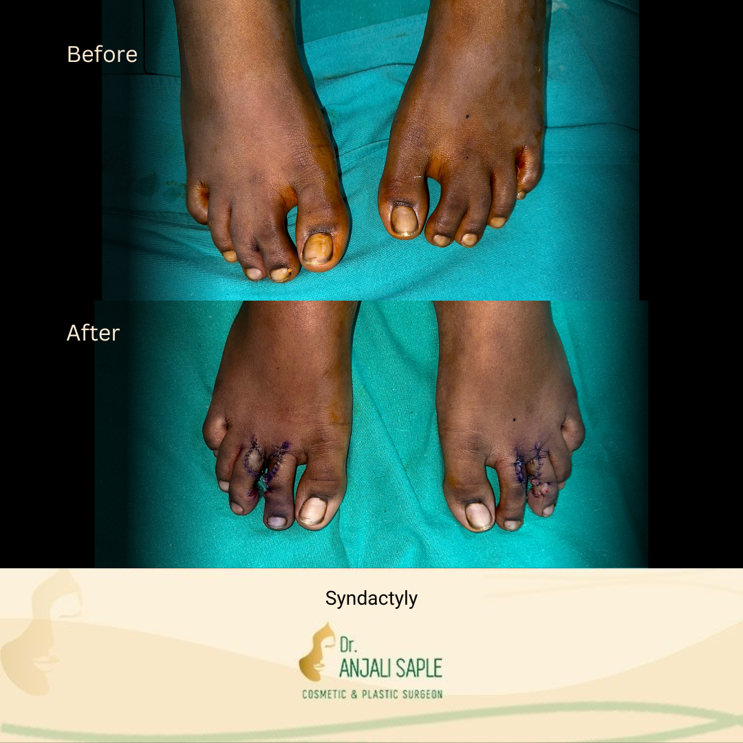 This image shows a before-and-after picture of the patient following surgery at Dr. Anjali Saple Clinic | Syndactyly