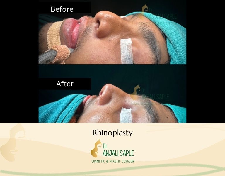This image shows a before-and-after picture of the patient following surgery at Dr. Anjali Saple Clinic | Rhinoplasty Left View