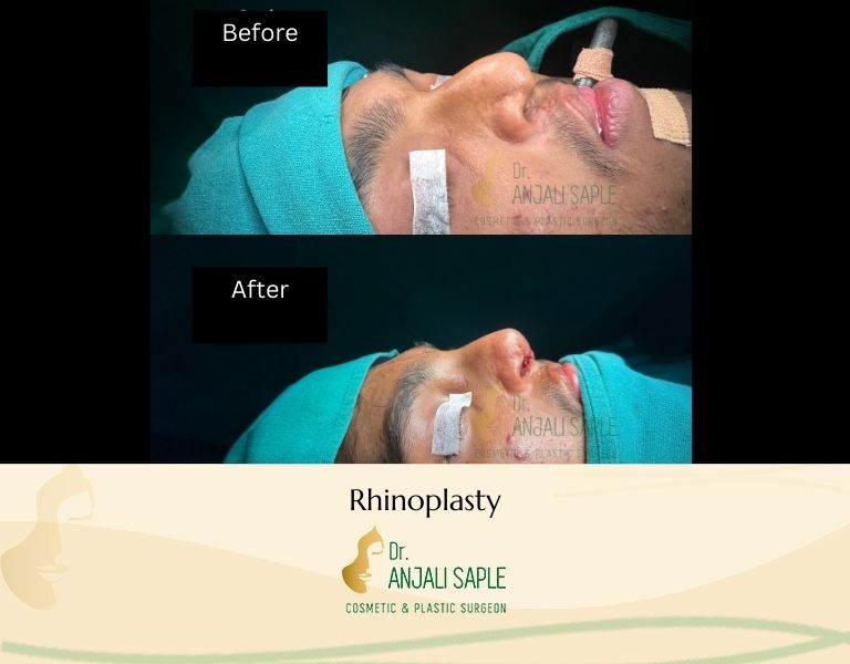 This image shows a before-and-after picture of the patient following surgery at Dr. Anjali Saple Clinic | Rhinoplasty Right View