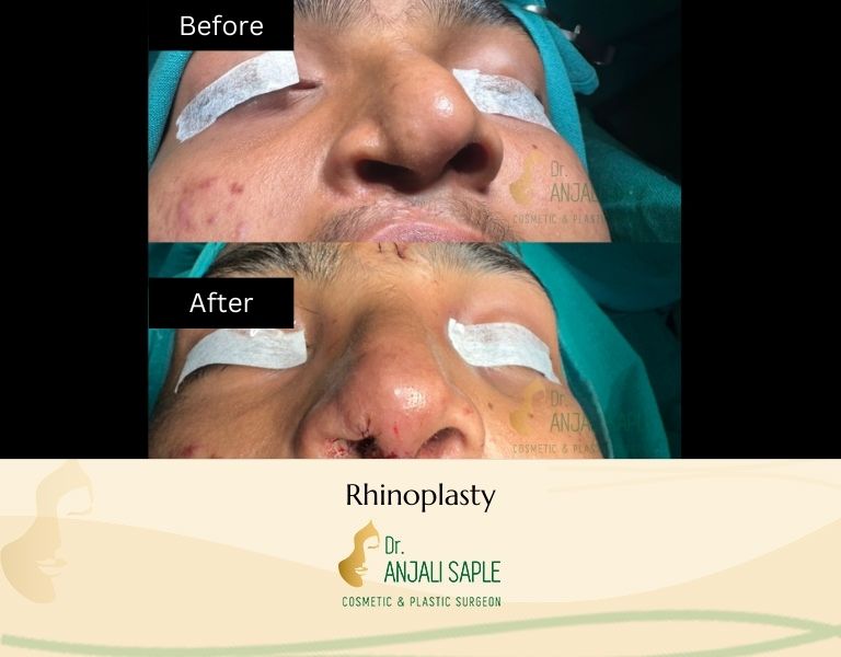 This image shows a before-and-after picture of the patient following surgery at Dr. Anjali Saple Clinic | Rhinoplasty