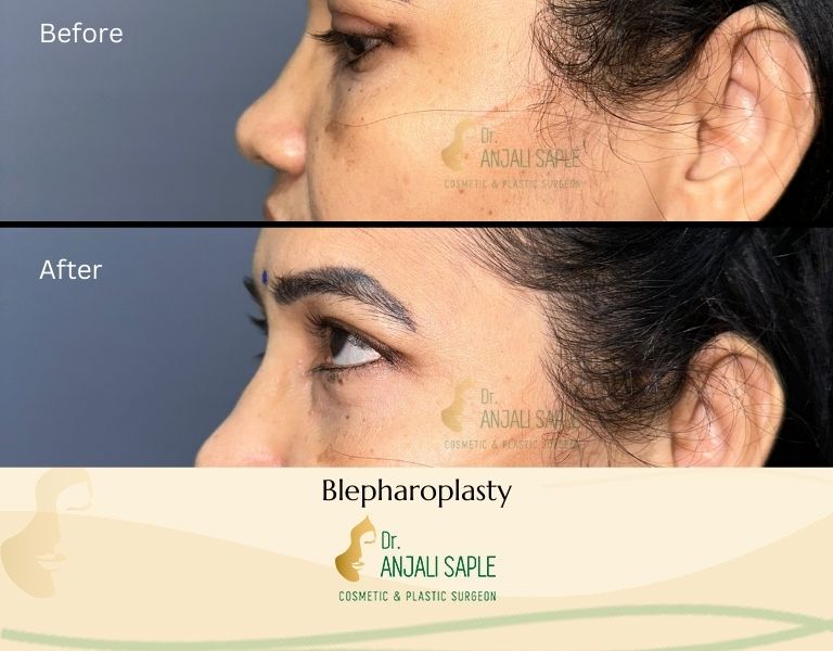 This image shows a before-and-after picture of the patient following surgery at Dr. Anjali Saple Clinic | Blepharoplasty Left view
