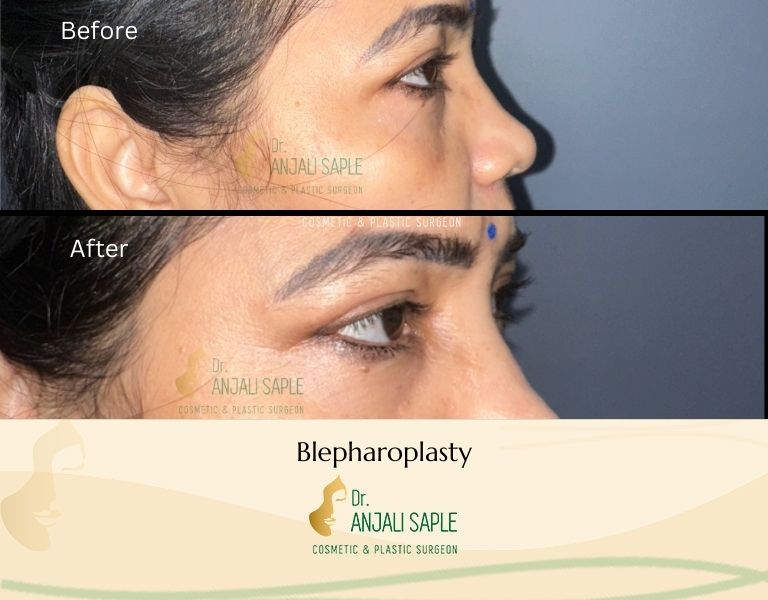 This image shows a before-and-after picture of the patient following surgery at Dr. Anjali Saple Clinic | Blepharoplasty Right view