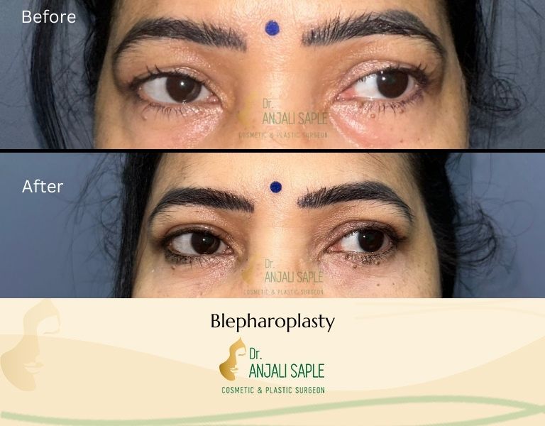 This image shows a before-and-after picture of the patient following surgery at Dr. Anjali Saple Clinic | Blepharoplasty Front view