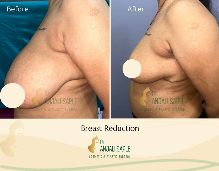 Breast Reduction Left View