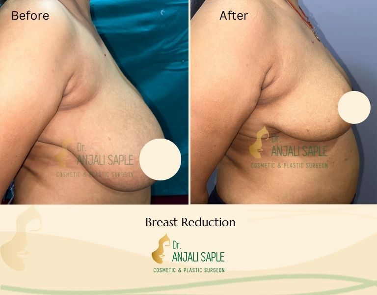 This image shows a before-and-after picture of the patient following surgery at Dr. Anjali Saple Clinic | Breast Reduction Right View