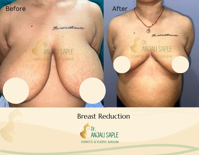 This image shows a before-and-after picture of the patient following surgery at Dr. Anjali Saple Clinic | Breast Reduction