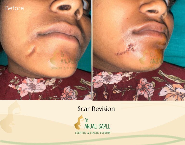 This image shows a before-and-after picture of the patient following surgery at Dr. Anjali Saple Clinic | Scar Revision