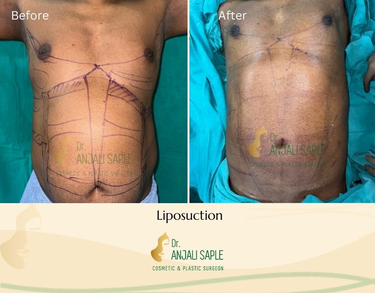 This image shows a before-and-after picture of the patient following surgery at Dr. Anjali Saple Clinic | Liposuction