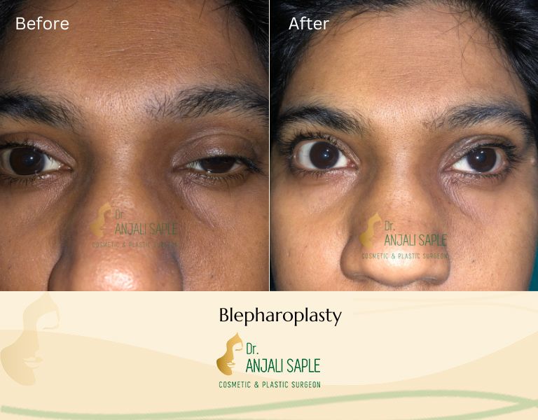 This image shows a before-and-after picture of the patient following surgery at Dr. Anjali Saple Clinic | Blepharoplasty