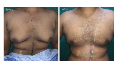 Case 1: Gynecomastia