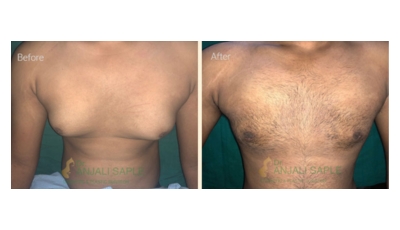 Case 3: Gynecomastia