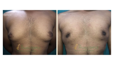 Case 4: Gynecomastia